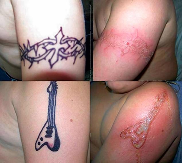 The charming Tattoo removal before and after red save photograph